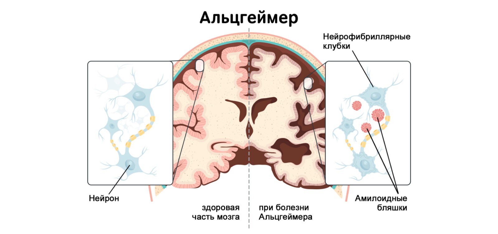 Деменция в вопросах и ответах: что происходит, зачем лечить и как предотвратить